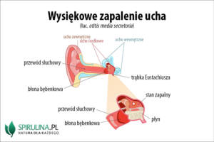 Wysiękowe zapalanie ucha