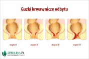 Guzki krwawnicze odbytu