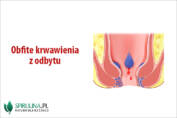 Obfite krwawienia z odbytu