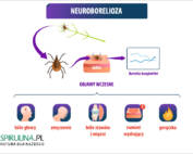 Neuroborelioza