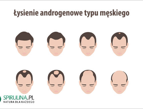Łysienie androgenowe typu męskiego