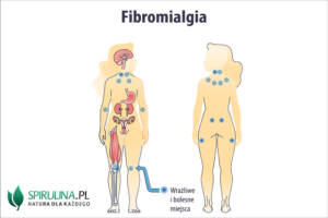 Fibromialgia