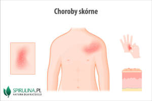 Choroby skórne