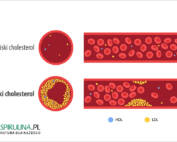 Wysoki cholesterol
