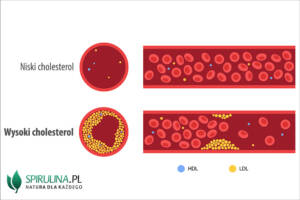 Wysoki cholesterol