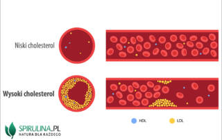 Wysoki cholesterol