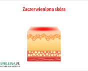 Zaczerwieniona skóra