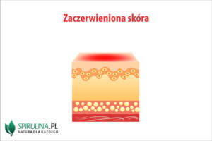 Zaczerwieniona skóra