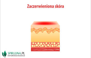 Zaczerwieniona skóra