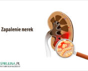 Zapalenie nerek