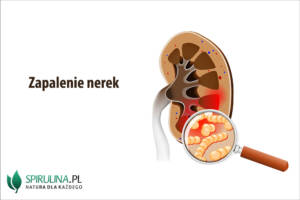 Zapalenie nerek