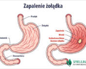 Zapalenie żołądka