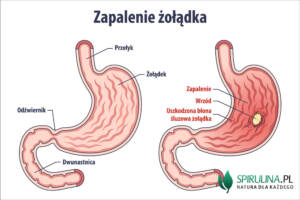 Zapalenie żołądka