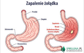 Zapalenie żołądka