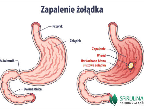 Zapalenie żołądka