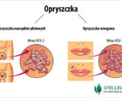 Opryszczka