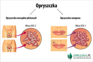 Opryszczka