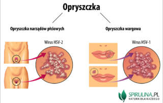 Opryszczka
