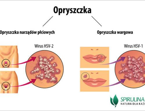 Opryszczka