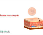 Rozszerzone naczynka