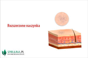 Rozszerzone naczynka