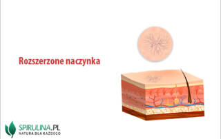 Rozszerzone naczynka