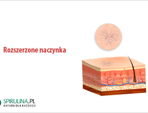 Rozszerzone naczynka