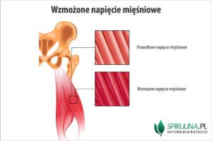 Wzmożone napięcie mięśniowe