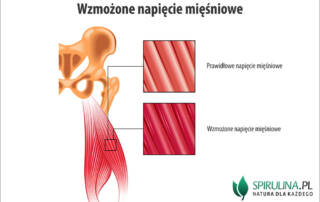 Wzmożone napięcie mięśniowe