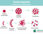 Anemia sierpowata (niedokrwistość sierpowatokrwinkowa)