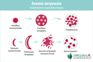 Anemia sierpowata (niedokrwistość sierpowatokrwinkowa)
