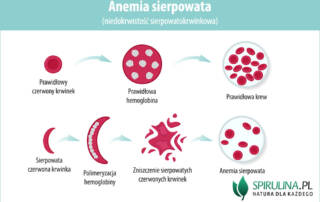 Anemia sierpowata (niedokrwistość sierpowatokrwinkowa)