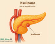 Insulinoma (wyspiak trzustki)