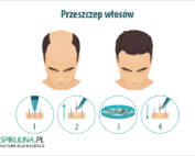 Przeszczep włosów
