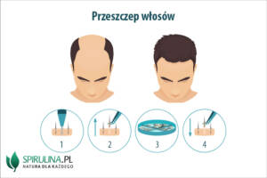 Przeszczep włosów