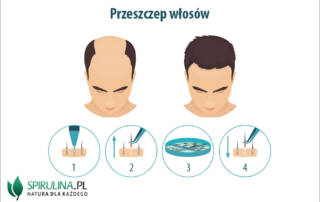 Przeszczep włosów