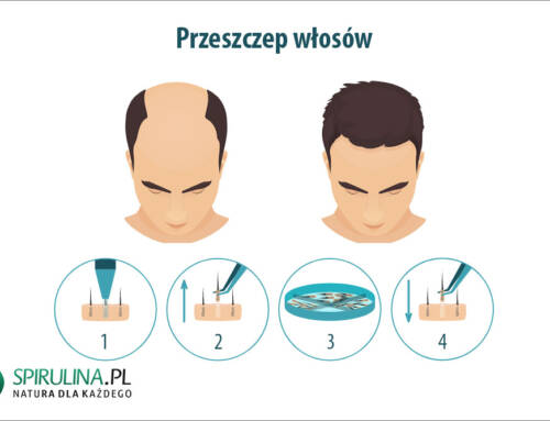 Przeszczep włosów