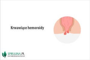 Krwawiące hemoroidy