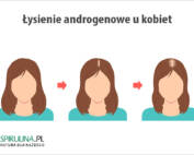Łysienie androgenowe u kobiet