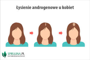 Łysienie androgenowe u kobiet