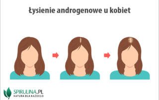 Łysienie androgenowe u kobiet