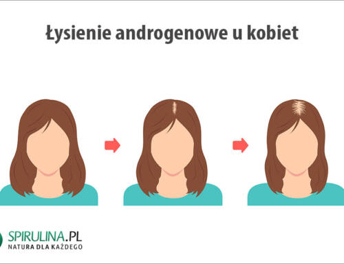 Łysienie androgenowe u kobiet