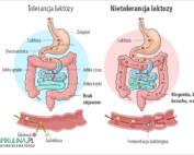 Nietolerancja laktozy