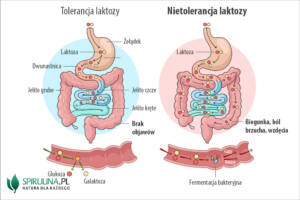 Nietolerancja laktozy