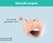 Opryszczka wargowa