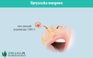 Opryszczka wargowa