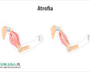 Atrofia