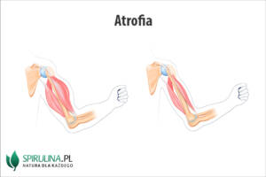 Atrofia