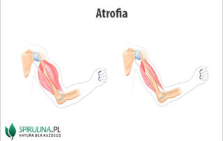 Atrofia