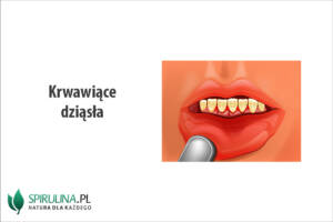 Krwawiące dziąsła